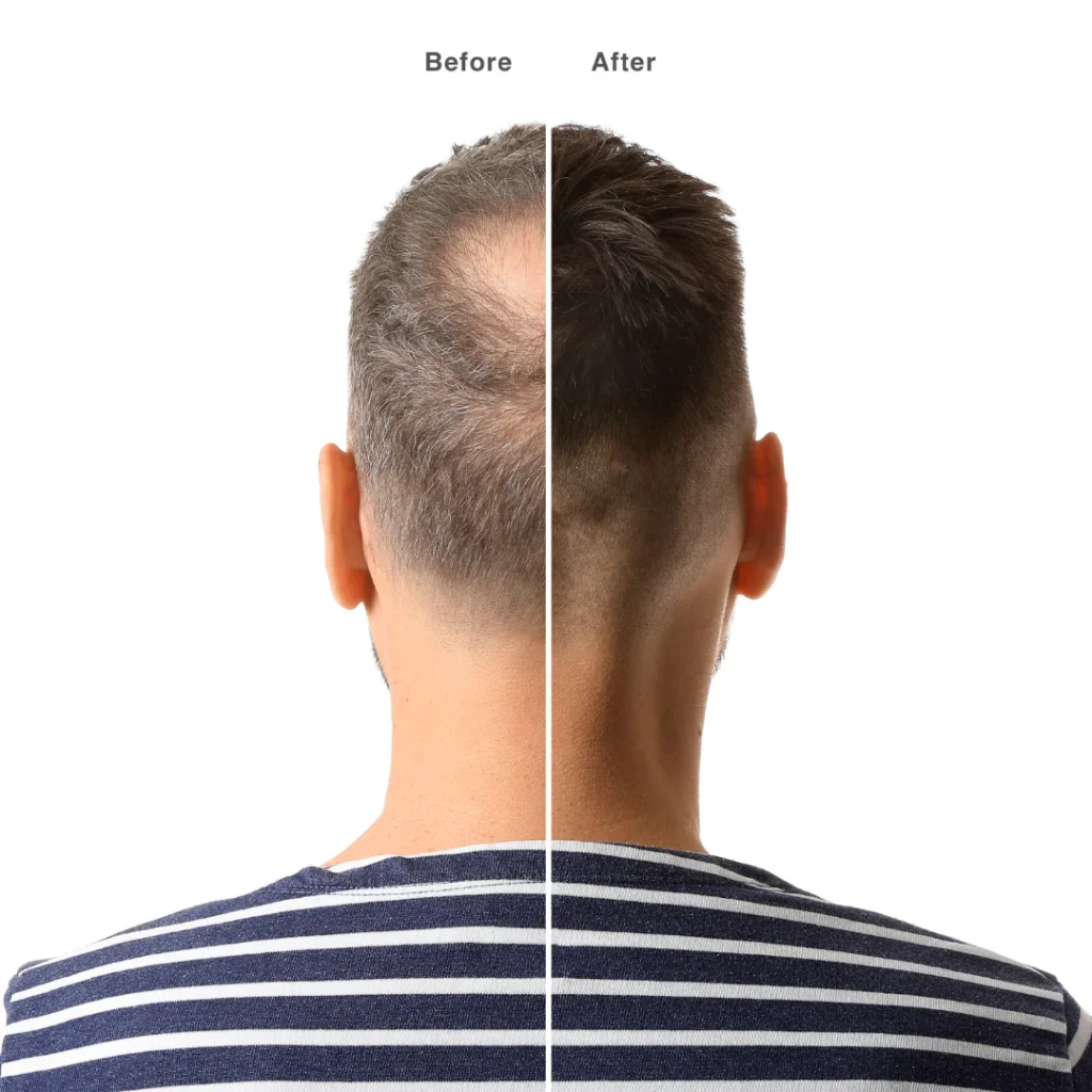 Before and after pics with Dutasteride medication