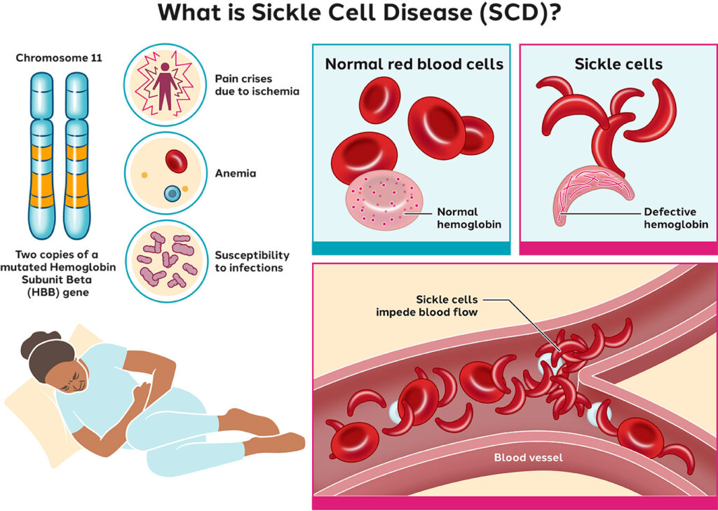 sickle cell