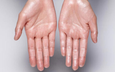 Sweaty hands? Here's what your body might be trying to tell you