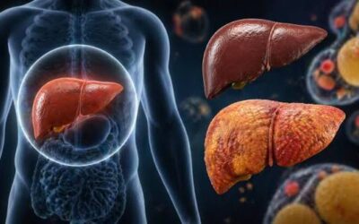 Fatty Liver Disease: 7 Warning Signs, Causes and How to Keep Your Liver Healthy.