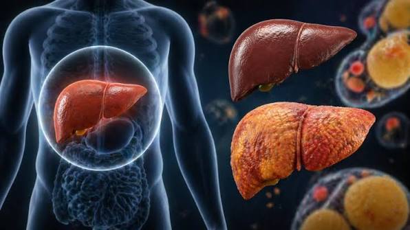 Fatty Liver Disease: 7 Warning Signs, Causes and How to Keep Your Liver Healthy.